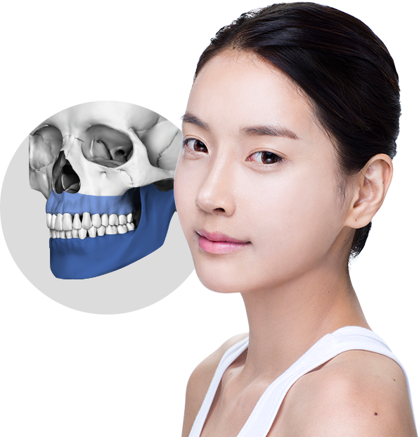 Phẫu thuật hai hàm là phẫu thuật chỉnh sửa cấu trúc của hàm