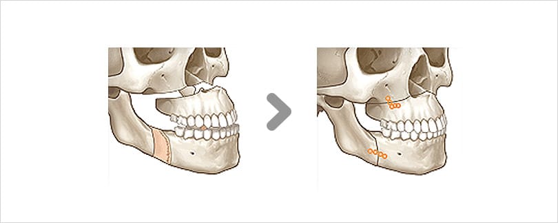 Phẫu thuật hai hàm chỉnh sửa cằm lưỡi cày