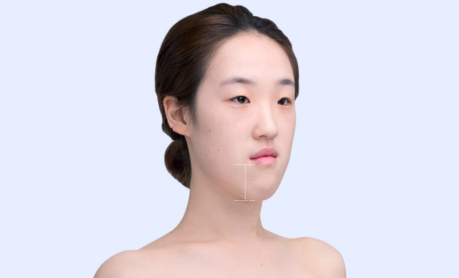 Phẫu thuật hai hàm cho khuôn mặt dài