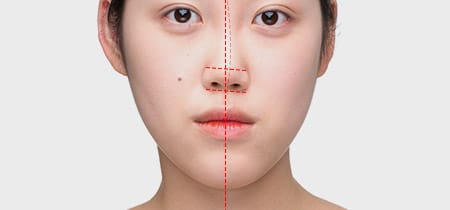 Trường hợp mũi bị cong vẹo làm cho khuôn mặt mất cân đối thì có thể cải thiện bằng việc điều chỉnh mũi bị cong.