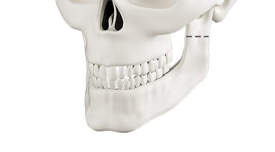 Cắt xương hai hàm thông thường