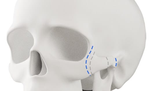 Phạm vi cắt xương hạ gò má ở BANOBAGI