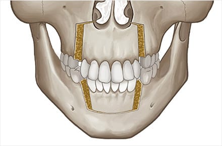 Phẫu thuật miệng hô Banobagi làm di chuyển điểm A một cách hiệu quả hơn.