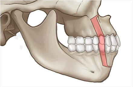 Phẫu thuật miệng hô Banobagi làm di chuyển điểm A một cách hiệu quả hơn.