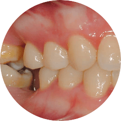Sâu răng và khớp cắn lệch cấp 2