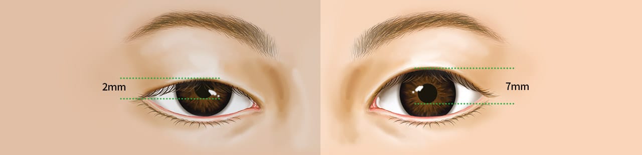 Điều chỉnh cơ mắt Trước&Sau