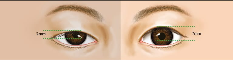Điều chỉnh cơ mắt Trước&Sau