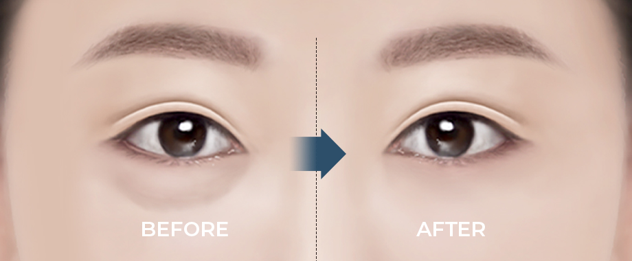Nhóm chuyên gia chỉnh hình mắt Banobagi có sự hiểu biết sâu, và có kĩ thuật về mắt.