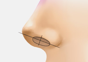 Nhiều loại hình vách ngăn mũi phong phú - case1