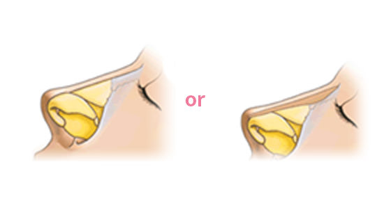 STEP 03 Thực hiện cắt, cấy ghép bằng sụn tự thân thay vì chất độn nhân tạo, Đối với trường hợp mũi thấp, thực hiện nâng sống mũi đồng thời cấy ghép chất độn với hiệu quả có thể ngăn ngừa sự tái phát triển
