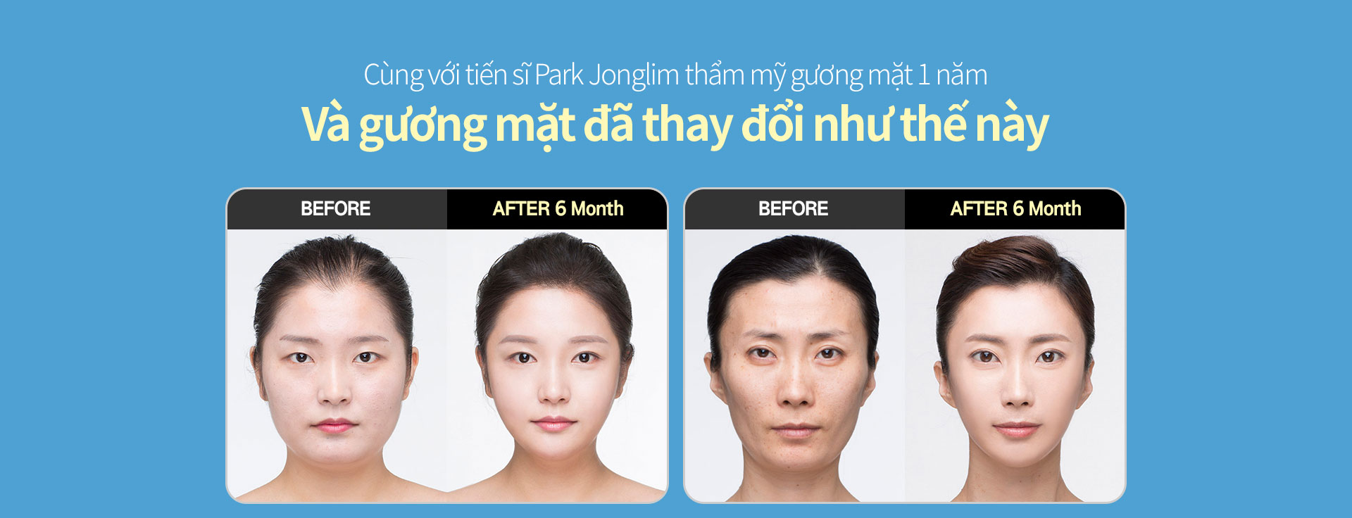 Cùng với tiến sĩ Park Jonglim thẩm mỹ gương mặt 1 năm Và gương mặt đã thay đổi như thế này