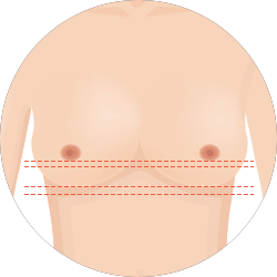 Tái phẫu thuật ngực trường hợp ngực không cân xứng