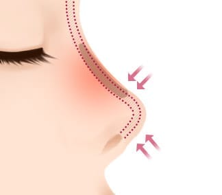 Trường hợp đầu mũi bị hếch và ngắn lại do sự ảnh hưởng của sự co rút