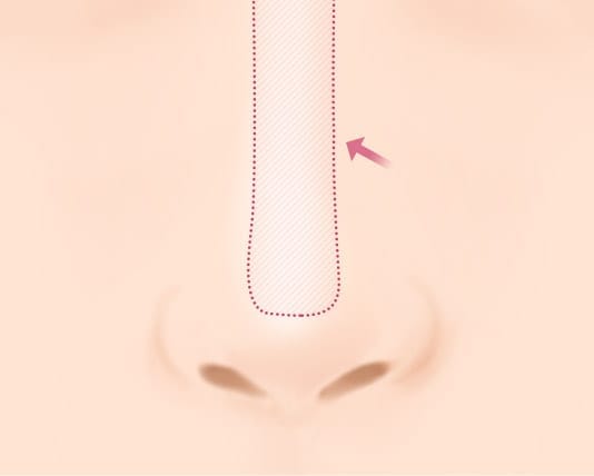 Trường hợp lộ silicon ở sống mũi