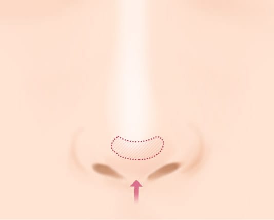 Trường hợp đầu mũi nhìn bóng hoặc sụn cấy vào bị lệch