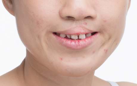 Trường hợp hàm răng hoặc mặt phát triển lệch